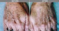 laser mole removal hands
